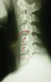Phase II Arthritis: the disc material between the two bones (circled) is losing height! You can now see that the outlined shape of the bones is different.